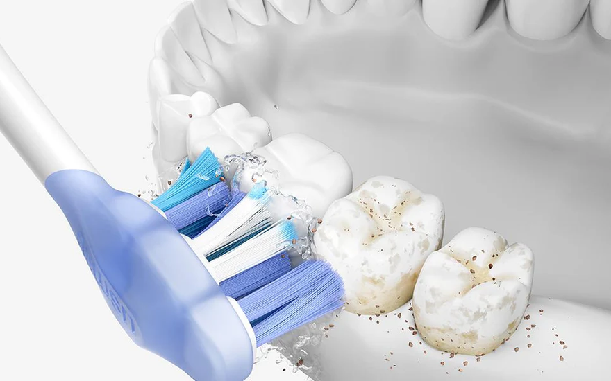 Plaque Teeth: What Causes It, How to Remove It, and How to Prevent Tartar